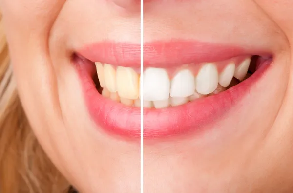 Teeth whitening treatment